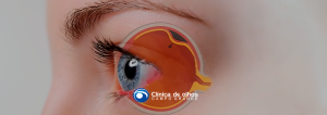 o que causa descolamento de retina